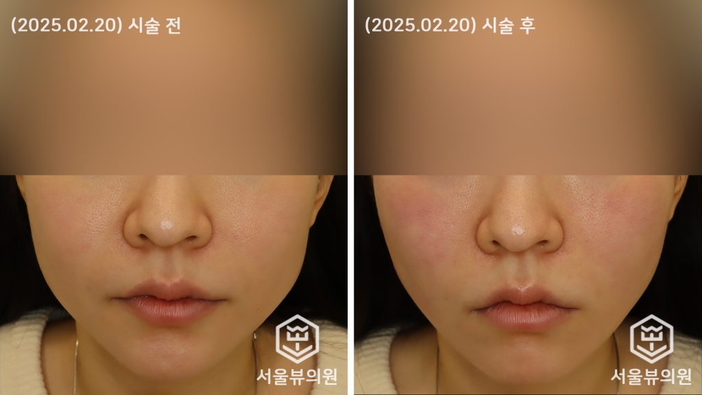 테쎄르 코그실 리프팅 12줄