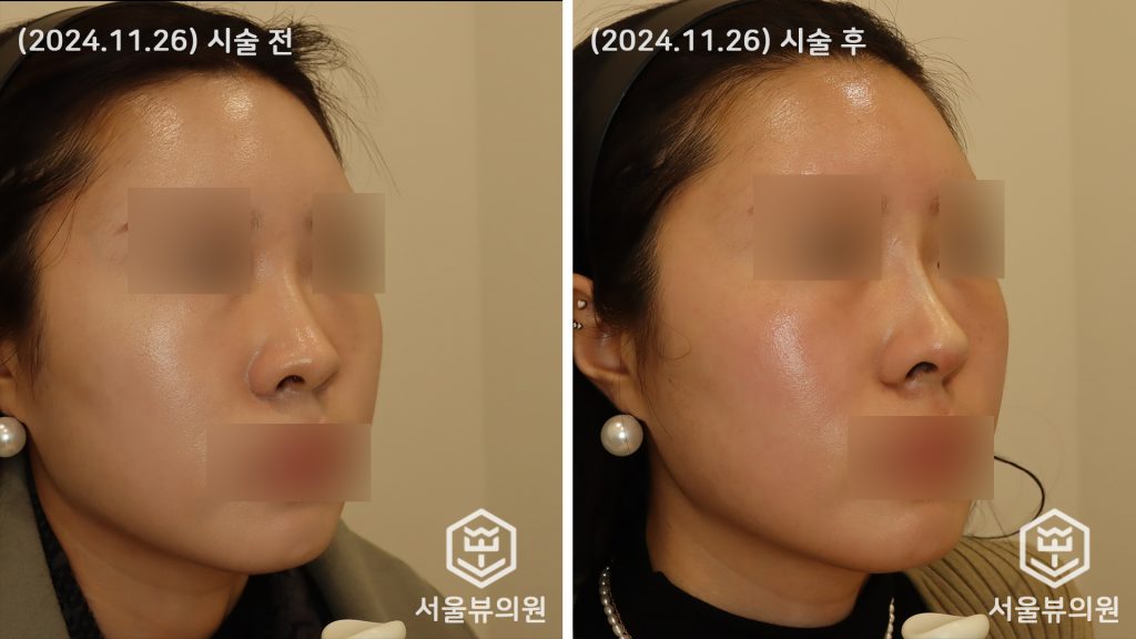 코 실리프팅1