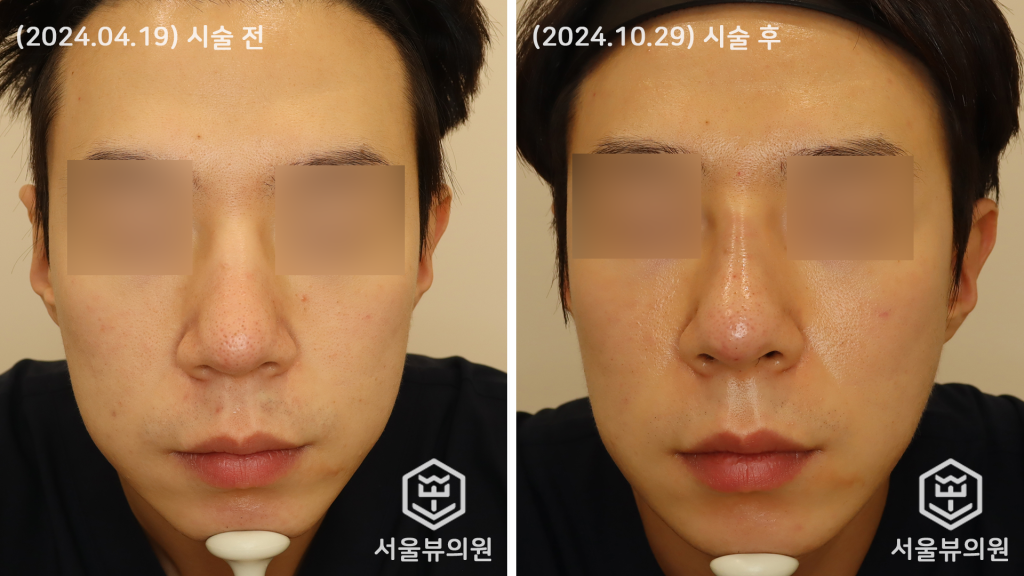 코 실리프팅5