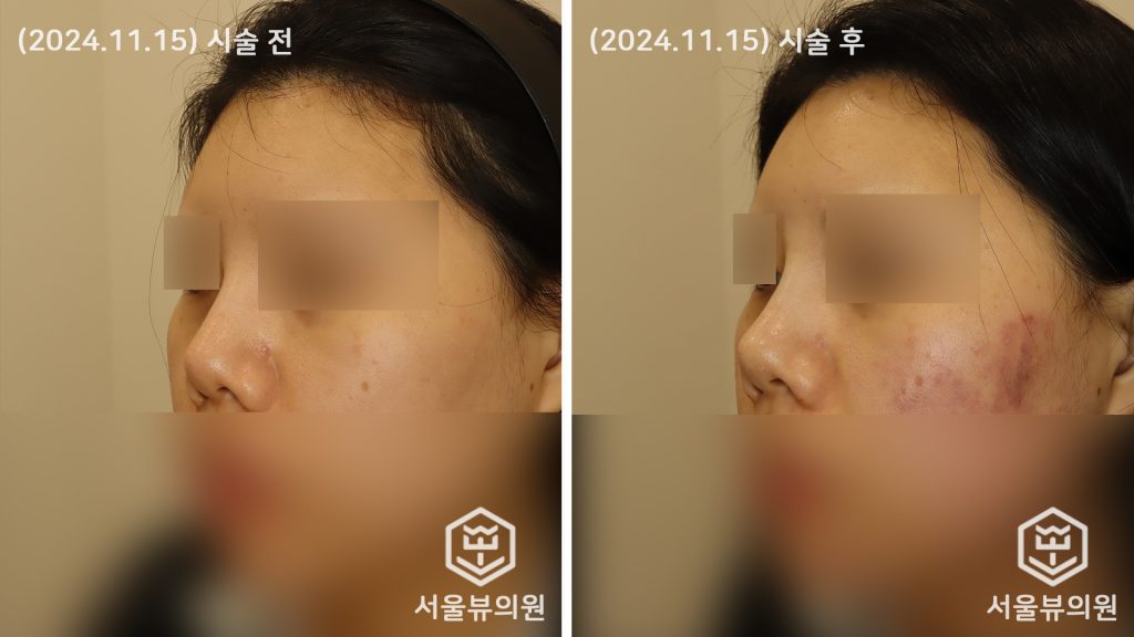 코 실리프팅4
