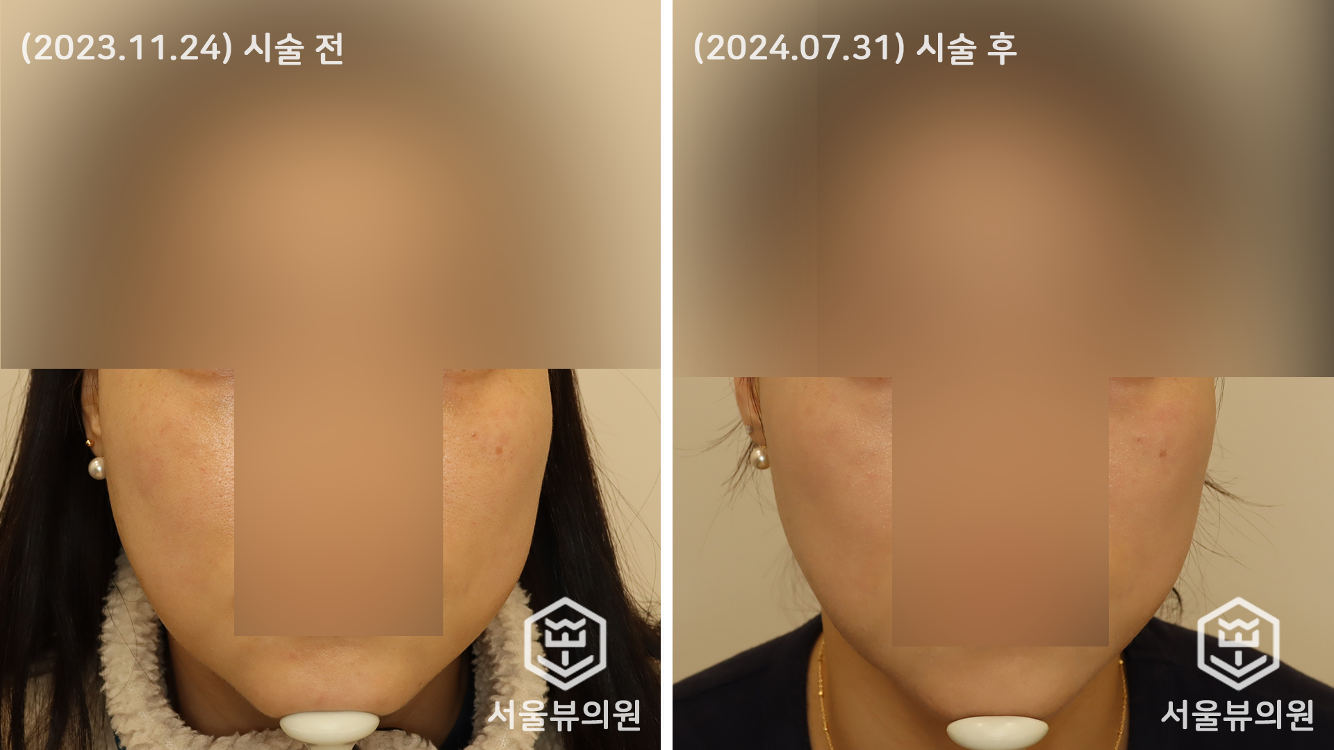 풀페이스 티타늄 + LDM 3회